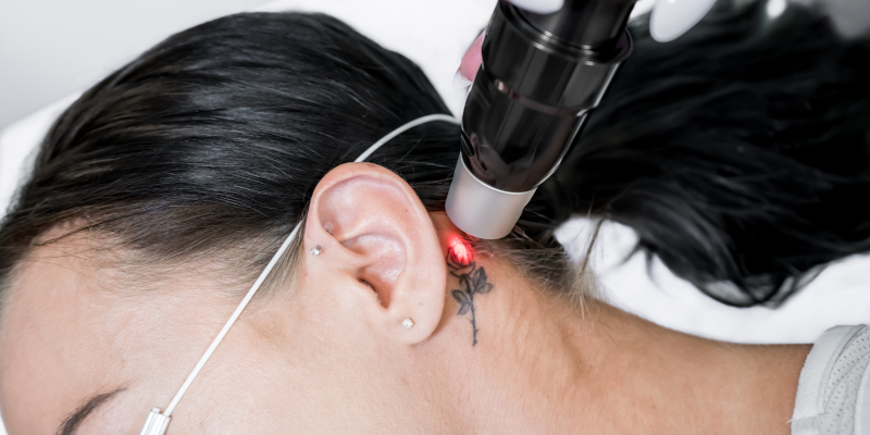3 Tips to Remember When Having Tattoos Removed by Lasers
